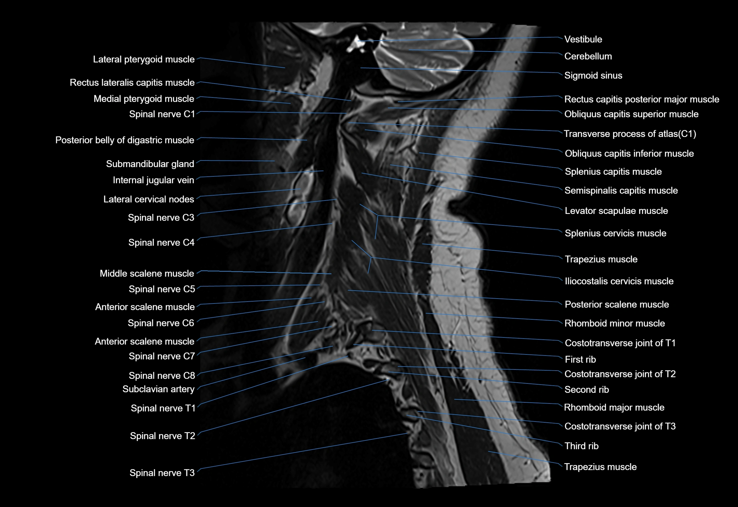 cervical spine cross sectional MRI anatomy 3T MRI  sagittal image-img-00001-00001.webp